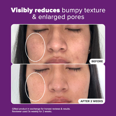 Niacinamide 20% Treatment