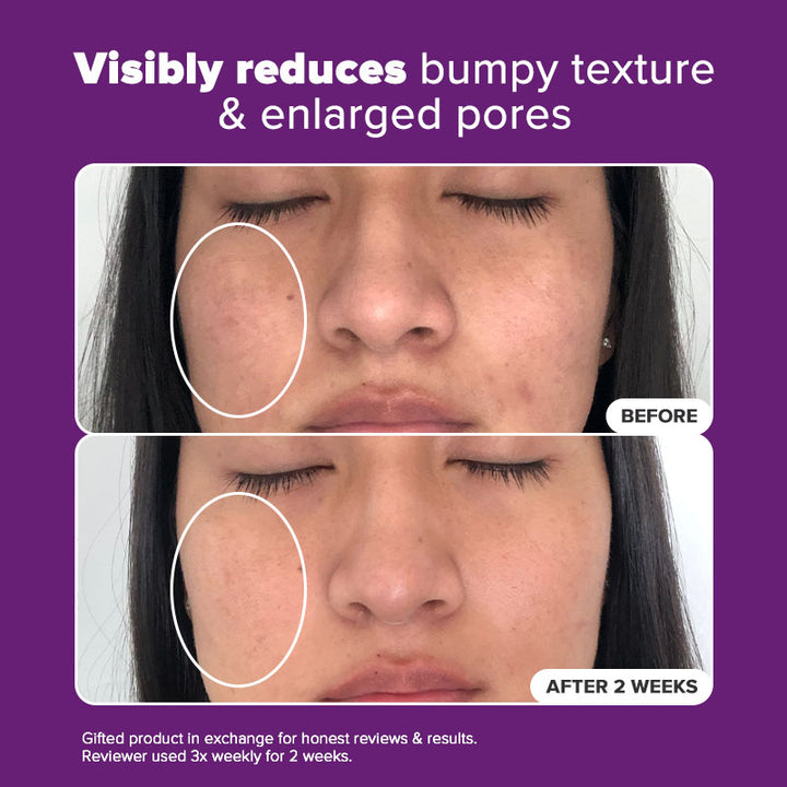 20% Clinical Niacinamide Treatment With Acetyl Glucosamine